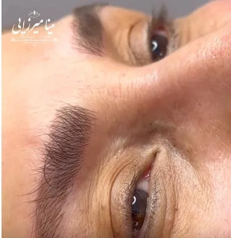 فیبروز ابرو