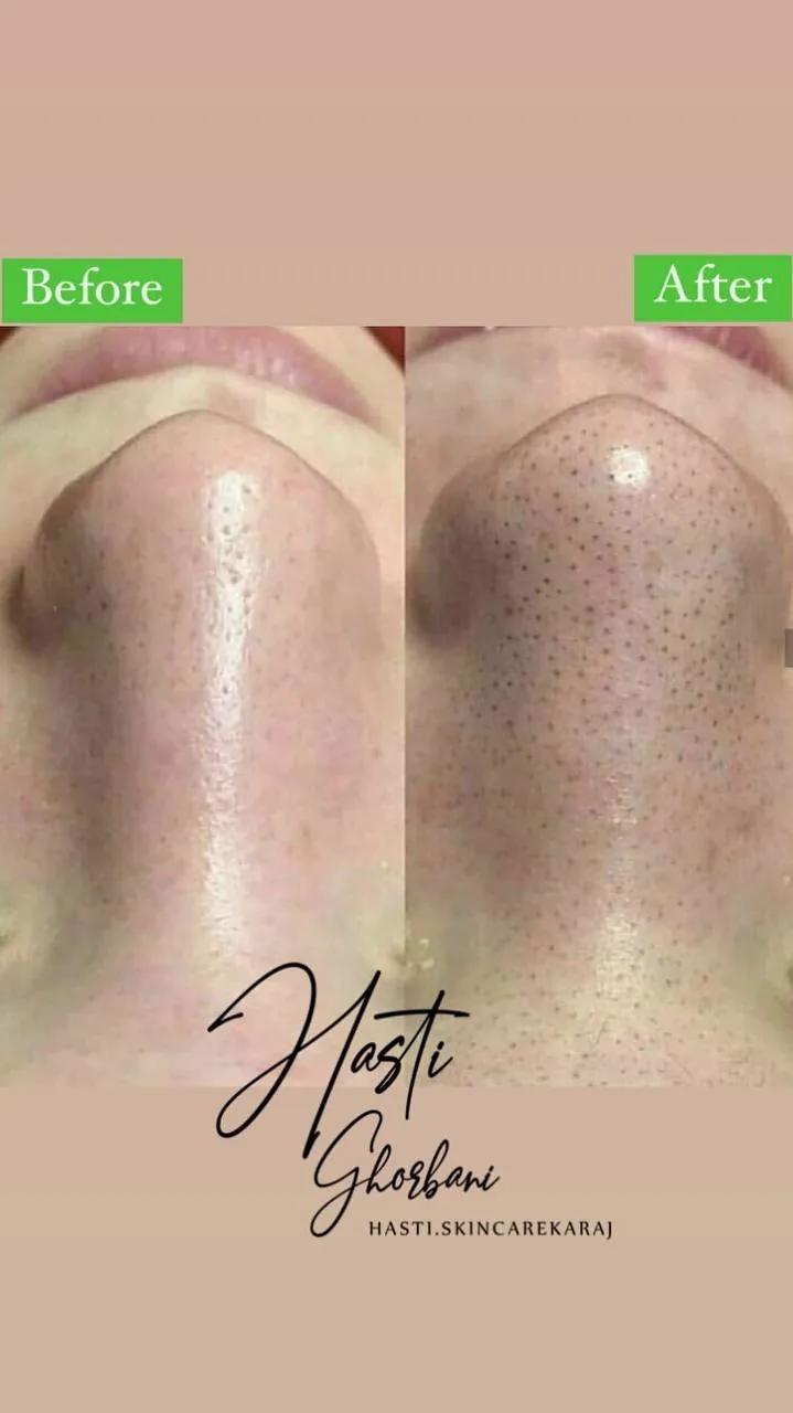 فشیال و پاکسازی پوست