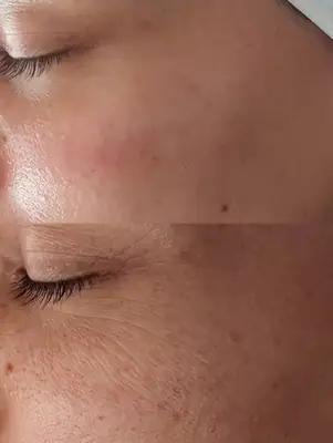 فیشال و پاکسازی پوست