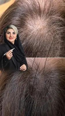 اسکالپ میکروپیگمنتیشن