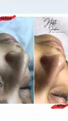 فشیال و پاکسازی پوست