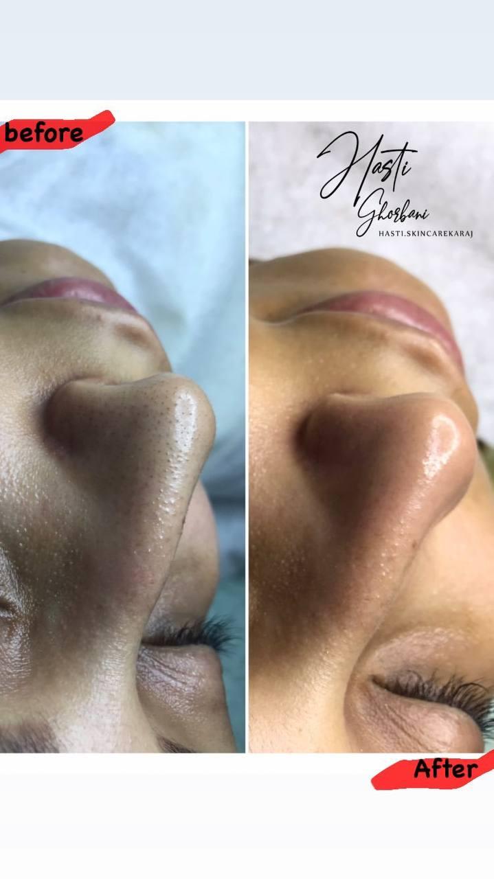 فشیال و پاکسازی پوست