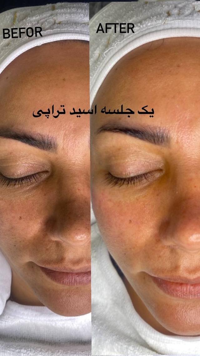 اسید تراپی