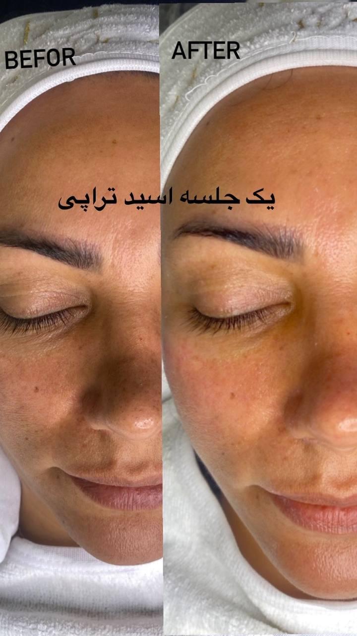 اسید تراپی