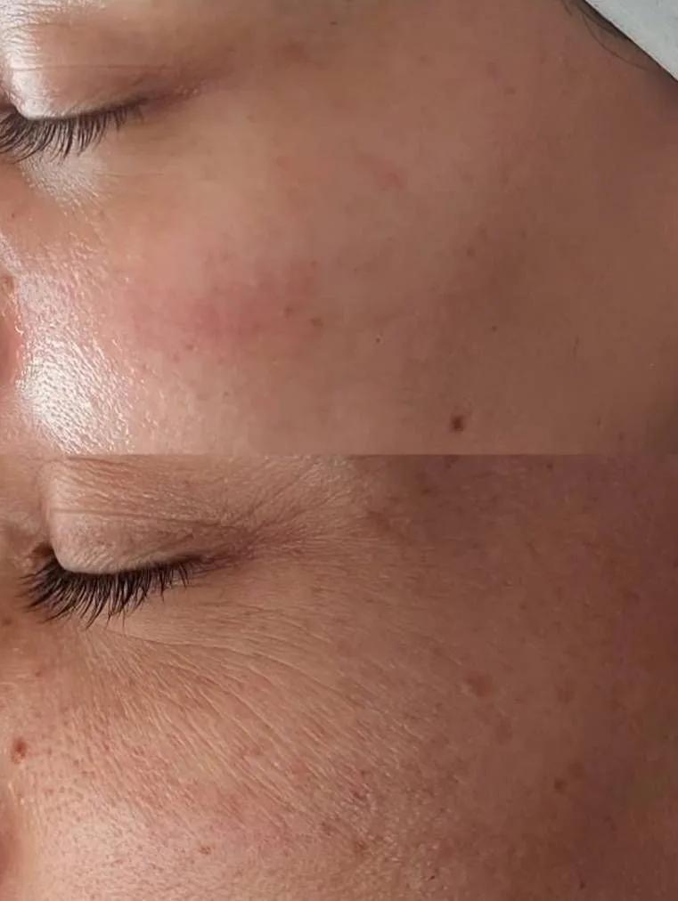 فیشال و پاکسازی پوست
