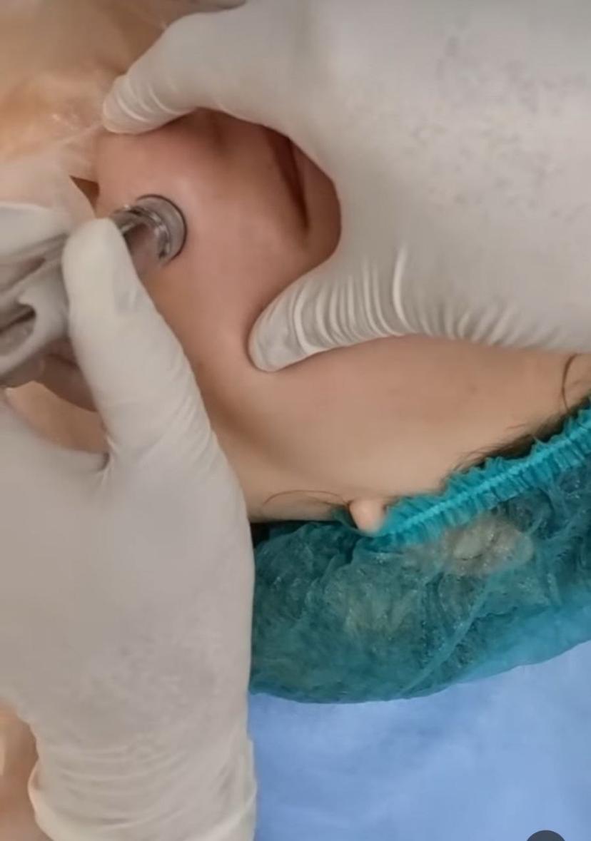 میکرودرم الماسی