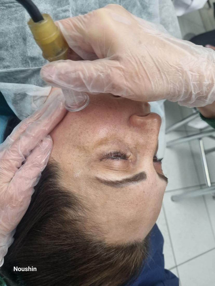 وکیوم ماساژ